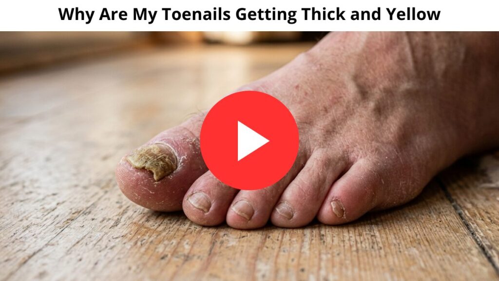 Why Are My Toenails Getting Thick and Yellow? The Hidden Danger Doctors Don't Talk About (2026) 2 Why Are My Toenails Getting Thick and Yellow