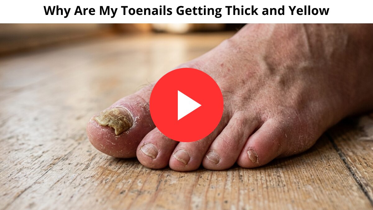 Why Are My Toenails Getting Thick and Yellow? The Hidden Danger Doctors Don't Talk About (2026) 1 Why Are My Toenails Getting Thick and Yellow
