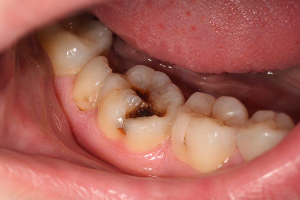 Why Do I Still Get Cavities Even Though I Brush Every Day?