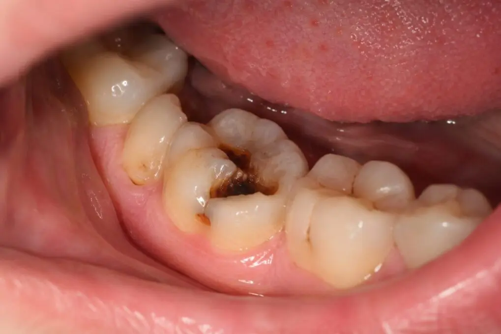 Why Do I Still Get Cavities Even Though I Brush Every Day?